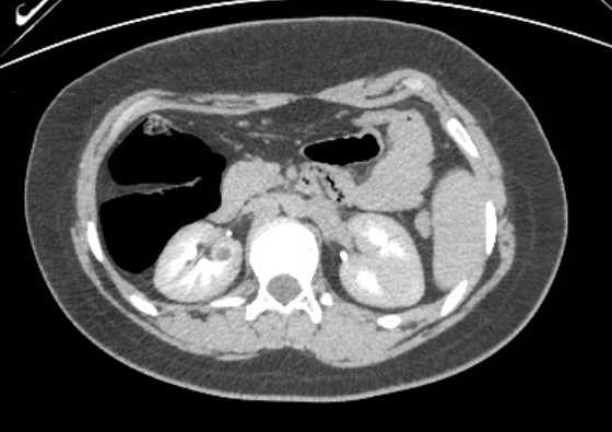 Acute unilateral nonhemorrhagic adrenal infarction (Radiopaedia 67560-76957 Axial renal excretory phase 71).jpg