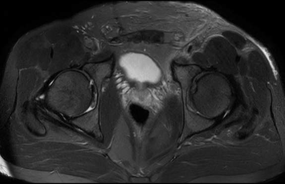 File:Adductor longus tear with retraction (Radiopaedia 56424-63103 Axial T2 fat sat 14).jpg