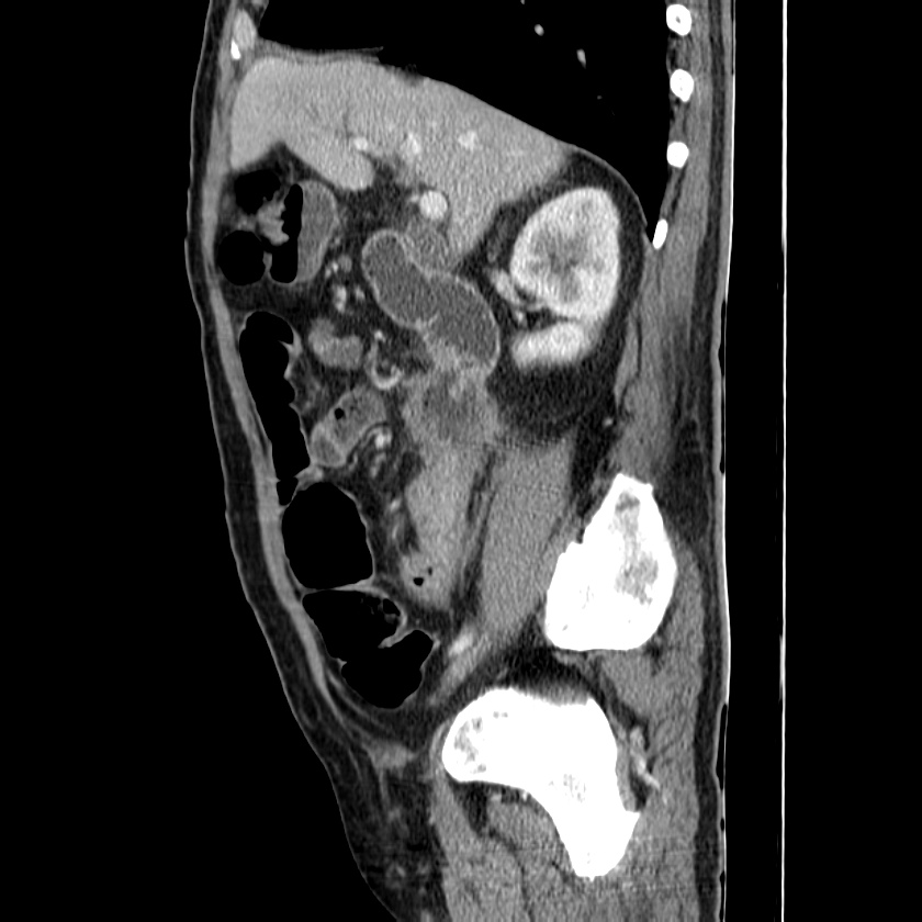 Adenocarcinoma of colon with entero-colic fistula (Radiopaedia 22832-22852 Sagittal C+ portal venous phase 23).jpg