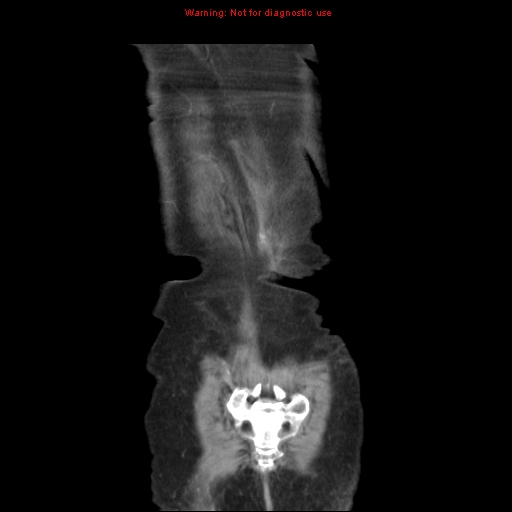 File:Adenocarcinoma of the colon (Radiopaedia 8191-9039 Coronal liver window 45).jpg