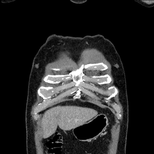 Adenocarcinoma of the lung (Radiopaedia 59871-67325 Coronal C+ arterial phase 4).jpg