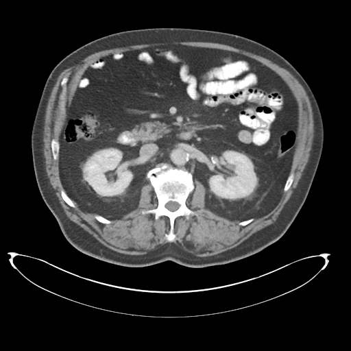 Adenocarcioma of rectum- T1 lesion (Radiopaedia 36921-38547 Axial C+ portal venous phase 36).png
