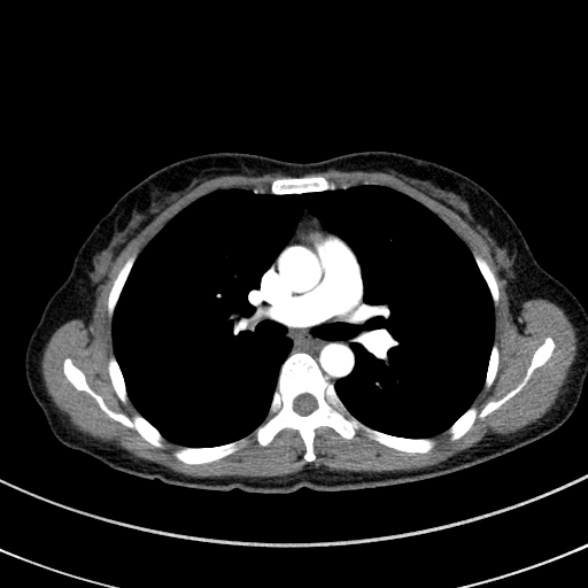 Adenocystic carcinoma of the trachea (Radiopaedia 47677-52525 Axial C+ arterial phase 49).jpg
