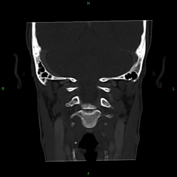 File:Adenoid cystic carcinoma of hard palate (Radiopaedia 26137-26273 Coronal bone window 29).jpg
