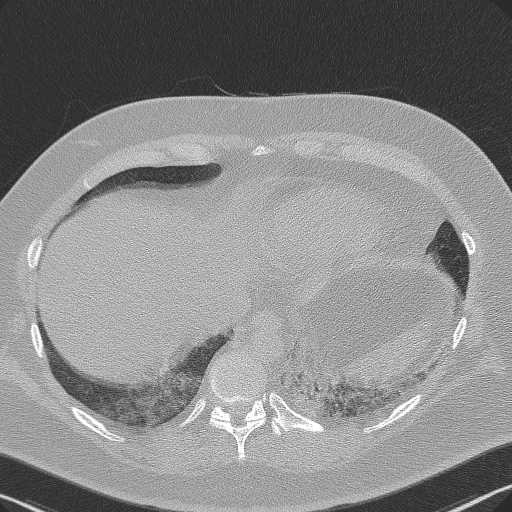 Adenoid cystic carcinoma of the trachea (Radiopaedia 49042-54137 Axial lung window 280).jpg