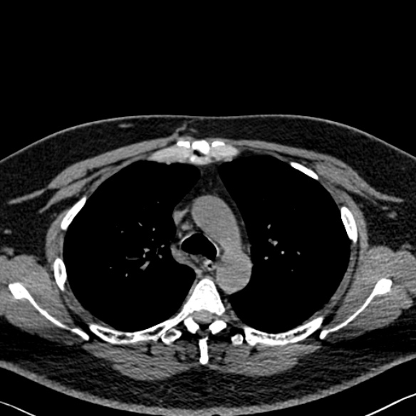 Adenoid cystic carcinoma of the trachea (Radiopaedia 49042-54137 Axial non-contrast 107).jpg
