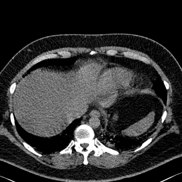 Adenoid cystic carcinoma of the trachea (Radiopaedia 49042-54137 Axial non-contrast 284).jpg