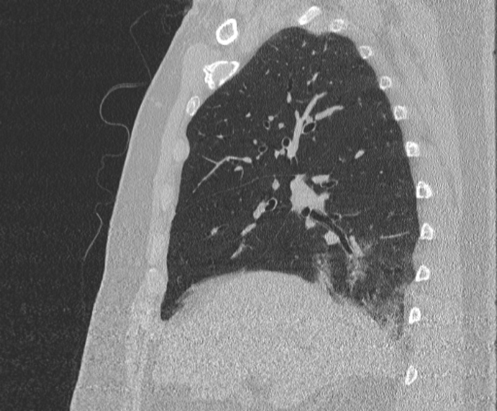 Adenoid cystic carcinoma of the trachea (Radiopaedia 49042-54137 Sagittal lung window 165).jpg