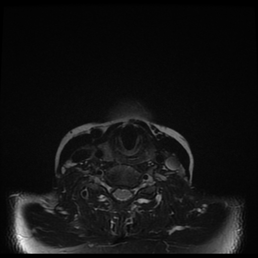 File:Adenoid cystic tumor of palate (Radiopaedia 46980-51519 Axial T2 fat sat 4).png