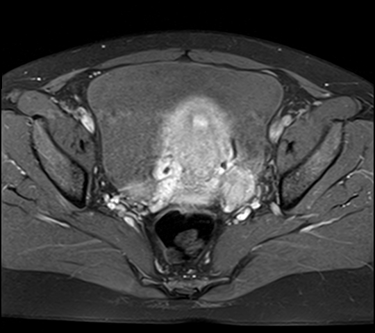 File:Adenomyosis - ovarian endometriomas (Radiopaedia 67031-76350 Axial T1 C+ fat sat 16).jpg