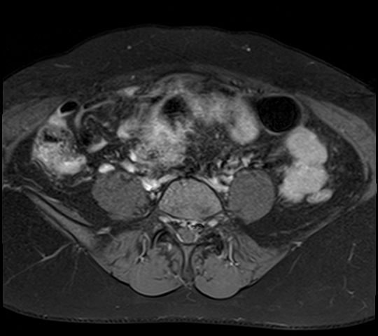 File:Adenomyosis - ovarian endometriomas (Radiopaedia 67031-76350 Axial T1 C+ fat sat 4).jpg