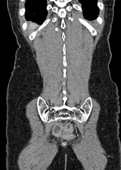Adhesional small bowel obstruction (Radiopaedia 48397-53305 Coronal C+ portal venous phase 305).jpg