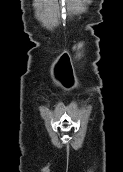 Adhesional small bowel obstruction (Radiopaedia 48397-53305 Coronal C+ portal venous phase 334).jpg