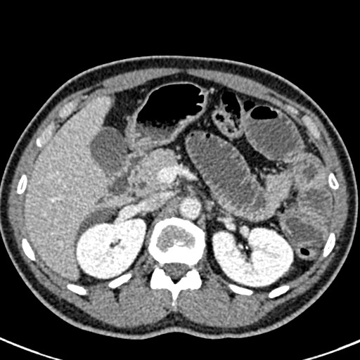 Adhesional small bowel obstruction (Radiopaedia 58900-66131 Axial C+ portal venous phase 17).jpg
