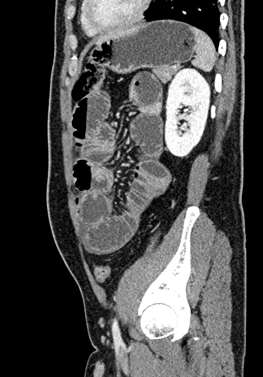 Adhesional small bowel obstruction (Radiopaedia 58900-66131 Sagittal C+ portal venous phase 184).jpg