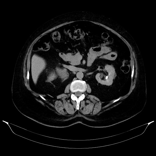 Adrenal cortical carcinoma (Radiopaedia 64017-72769 Axial C+ delayed 30).jpg