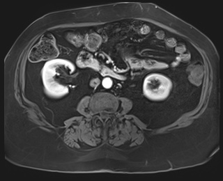 Adrenal cortical carcinoma (Radiopaedia 64017-72770 I 55).jpg