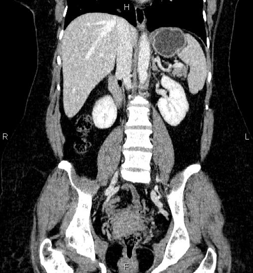 Adrenal cortical carcinoma (Radiopaedia 84882-100379 Coronal C+ portal venous phase 38).jpg