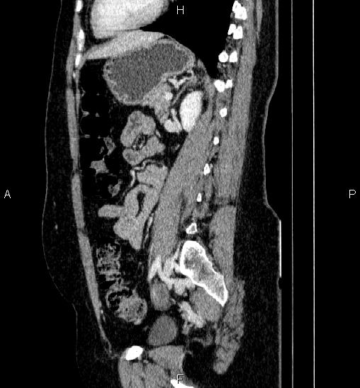 Adrenal cortical carcinoma (Radiopaedia 84882-100379 Sagittal C+ portal venous phase 57).jpg