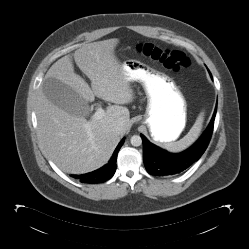 File:Adrenal cyst (Radiopaedia 45625-49776 Axial C+ portal venous phase 22).png