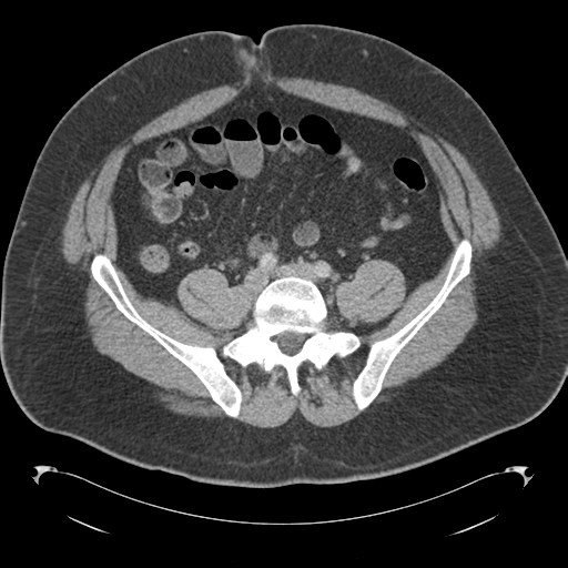 File:Adrenal cyst (Radiopaedia 45625-49776 Axial C+ portal venous phase 67).png