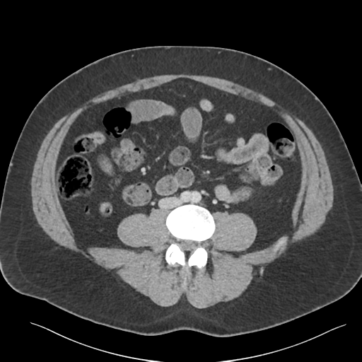 Adrenal cyst (Radiopaedia 45625-49777 Axial C+ portal venous phase 62).png