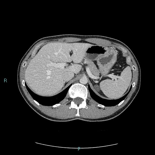 Adrenal cystic lymphangioma (Radiopaedia 83161-97534 Axial C+ portal venous phase 25).jpg