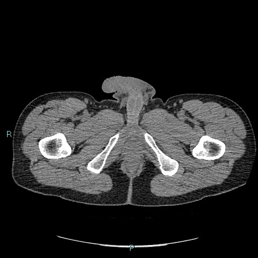 Adrenal cystic lymphangioma (Radiopaedia 83161-97534 Axial non-contrast 109).jpg