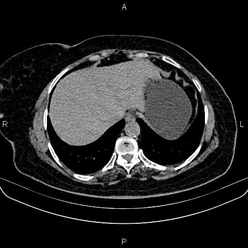Adrenal myelolipoma (Radiopaedia 82742-96986 Axial non-contrast 14).jpg