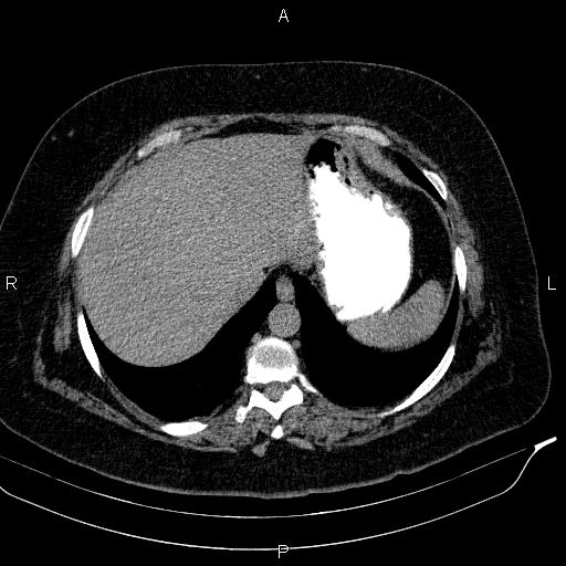 Adrenal myelolipoma (Radiopaedia 84319-99617 Axial With oral contrast 34).jpg