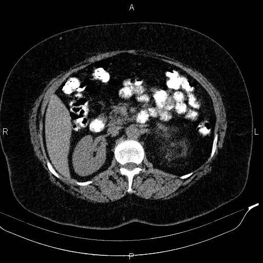 Adrenal myelolipoma (Radiopaedia 84319-99617 Axial With oral contrast 87).jpg