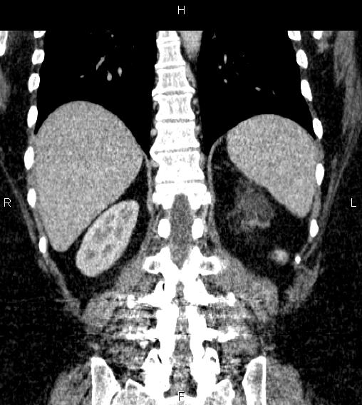 Adrenal myelolipoma (Radiopaedia 84319-99617 Coronal renal cortical phase 59).jpg
