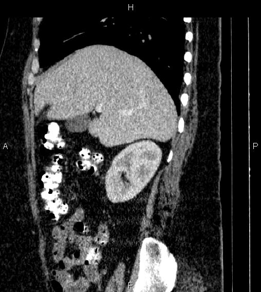 Adrenal myelolipoma (Radiopaedia 84319-99617 Sagittal renal cortical phase 26).jpg