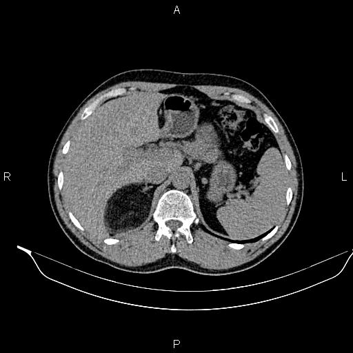 Adrenal myelolipoma (Radiopaedia 87794-104246 Axial non-contrast 28).jpg