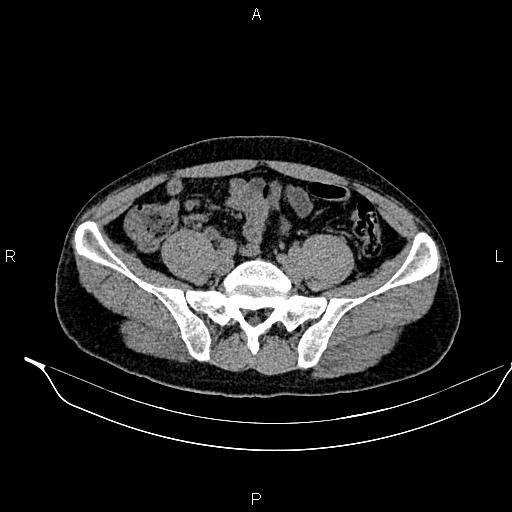 File:Adrenal myelolipoma (Radiopaedia 87794-104246 Axial non-contrast 77).jpg