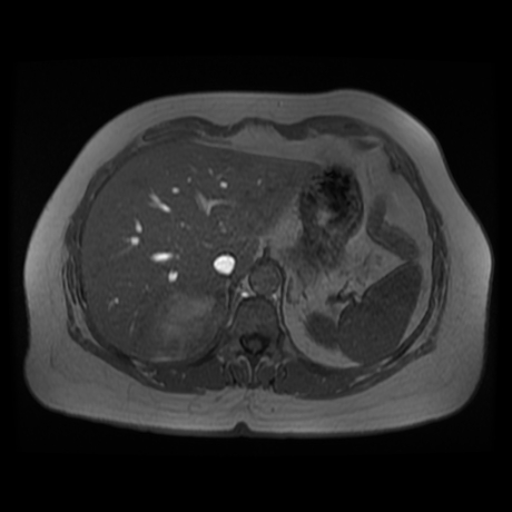 File:Adrenal myelolipoma - MRI (Radiopaedia 83249-97646 Axial T1-in phase 5).jpg