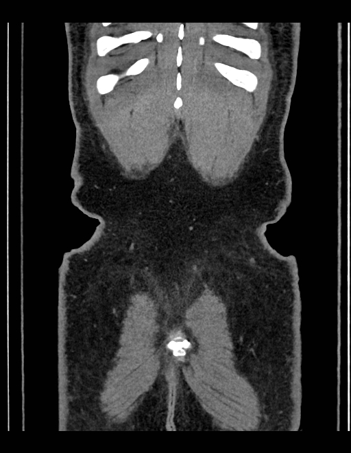 Adrenal myelolipoma - bilateral (Radiopaedia 74805-85810 Coronal C+ portal venous phase 49).jpg
