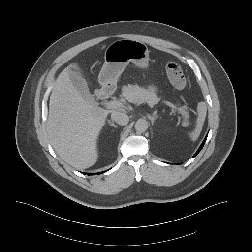 File:Adrenal vein sampling and adrenal nodular hyperplasia - Conn syndrome (Radiopaedia 30561-31337 Axial non-contrast 22).jpg