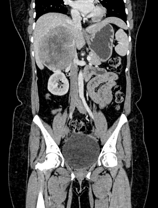 Adrenocortical carcinoma (Radiopaedia 87281-103569 Coronal C+ portal venous phase 43).jpg