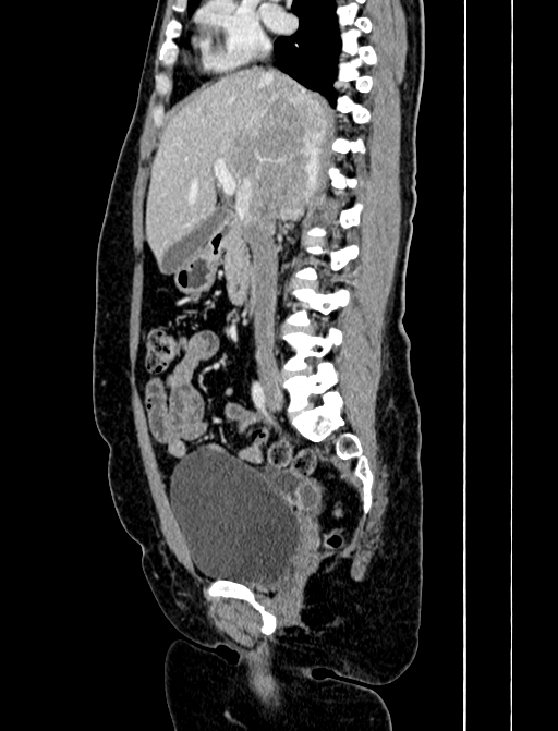 Adrenocortical carcinoma (Radiopaedia 87281-103569 Sagittal C+ portal venous phase 123).jpg
