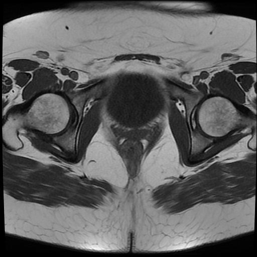 File:Adult granulosa cell tumor of the ovary (Radiopaedia 64991-73953 Axial T1 20).jpg