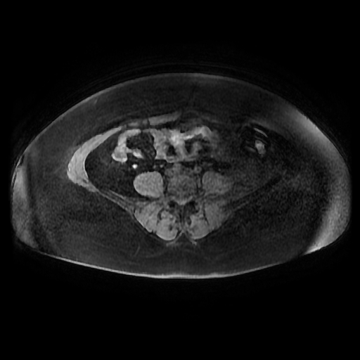 File:Adult granulosa cell tumor of the ovary (Radiopaedia 64991-73953 axial-T1 Fat sat post-contrast dynamic 1).jpg