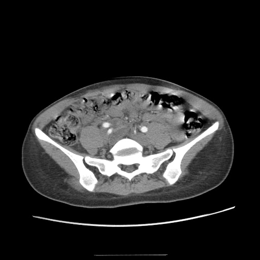 File:Adult polycystic kidney disease (Radiopaedia 48845-53876 Axial renal cortical phase 54).jpg