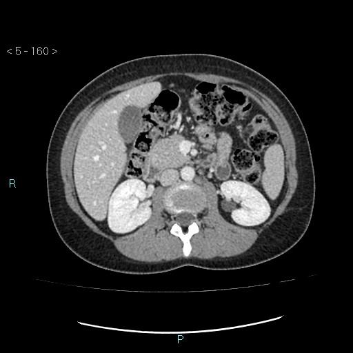 Adult transient intestinal intussusception (Radiopaedia 34853-36310 Axial C+ portal venous phase 22).jpg