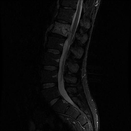 File:Aggressive vertebral hemangioma with pathological fracture (Radiopaedia 69528-79411 Sagittal STIR 5).jpg