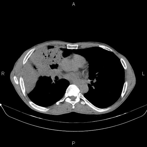 Air bronchogram in pneumonia (Radiopaedia 85719-101512 Axial non-contrast 36).jpg
