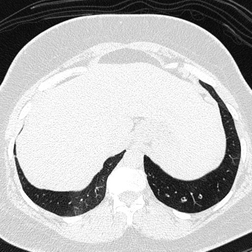 File:Air trapping in small airway disease (Radiopaedia 61685-69694 Axial lung window 173).jpg