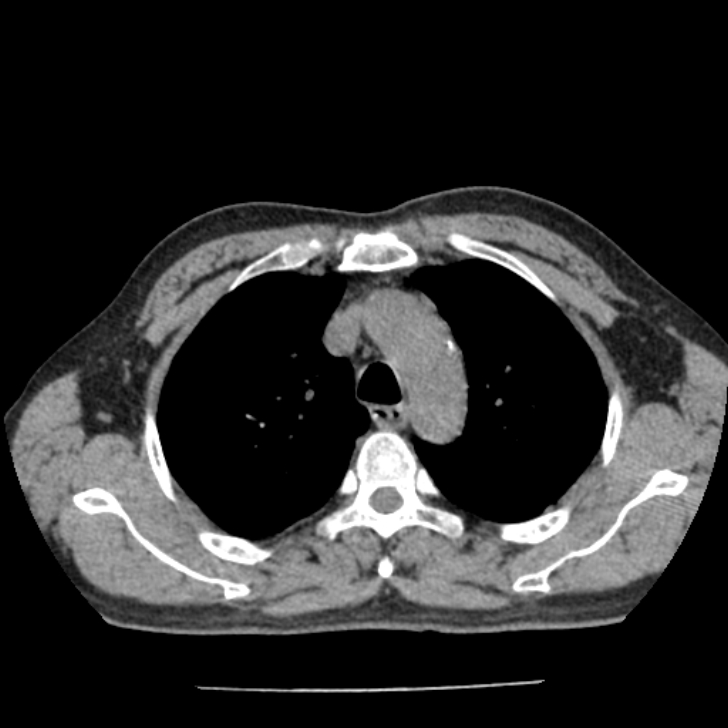 Airway foreign body in adult (Radiopaedia 85907-101779 Axial liver window 35).jpg