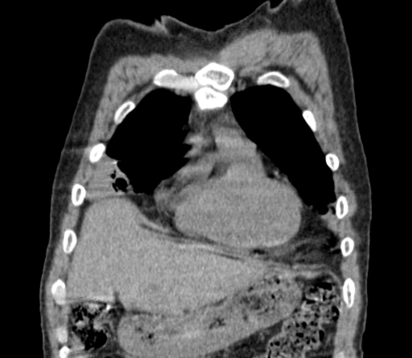 Airway foreign body in adult (Radiopaedia 85907-101779 Coronal liver window 45).jpg