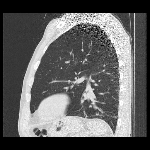 Allergic bronchopulmonary aspergillosis (ABPA) (Radiopaedia 60594-68313 Sagittal lung window 17).jpg